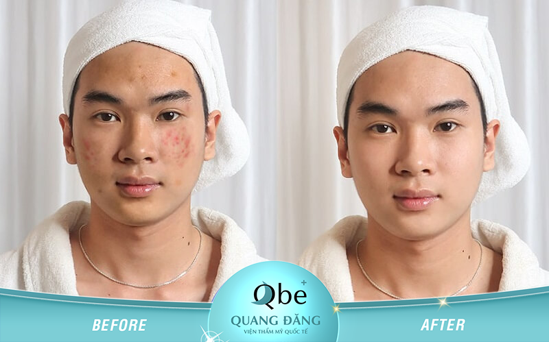 Trị Mụn - Chị Hương