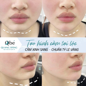 RF Vi kim — Trẻ hóa da không phẫu thuật